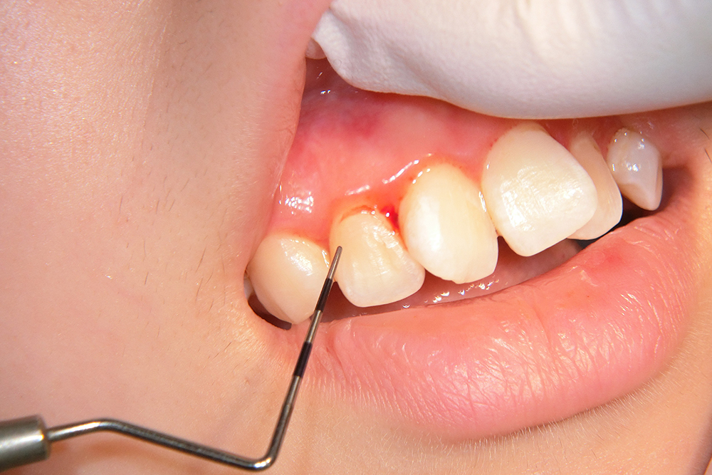 歯周病検査による歯肉からの出血