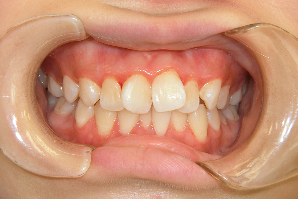 酸蝕歯の一例